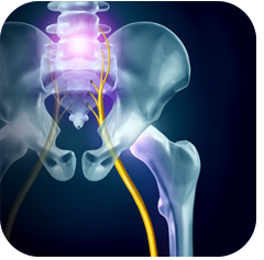 Sciatica