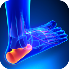 Heel Spurs