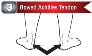 Bowed Achilles Tendons