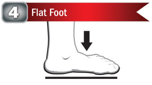 Flat Foot